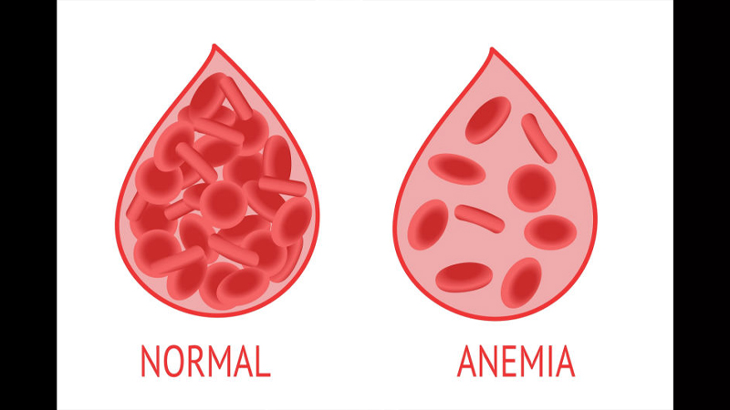 Anemia: Gejala dan Tips Pencegahan dari PAFI Kota Raha